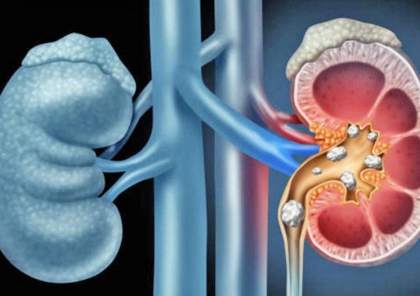 Shkaktojnë dhimbje të tmerrshme, mësoni si të shpejtoni nxjerrjen jashtë trupit të gurëve të veshkave