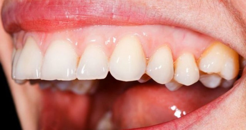 Çfarë problemi shëndetësor tregojnë mishrat e zbardhur të dhëmbëve dhe si trajtohen ato