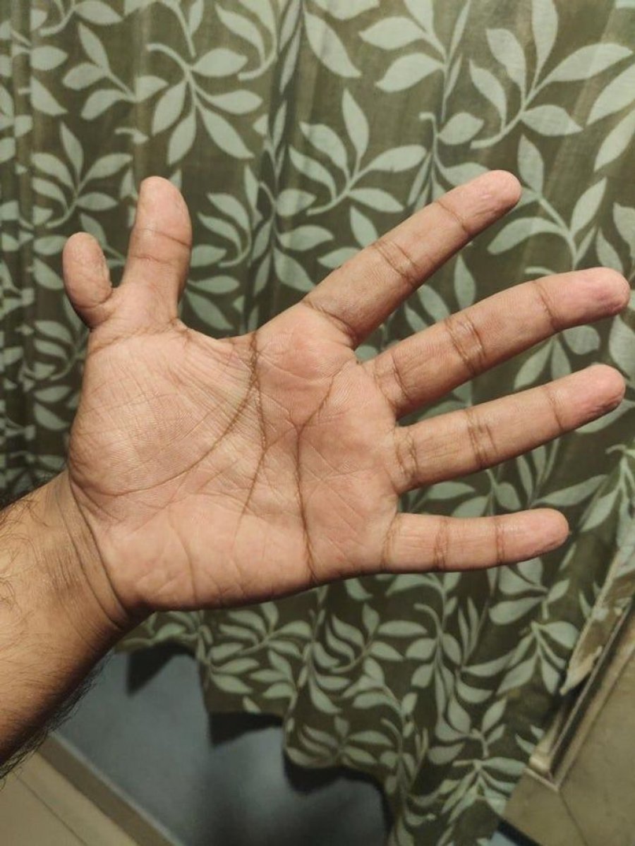 Рука с 6 пальцами фото