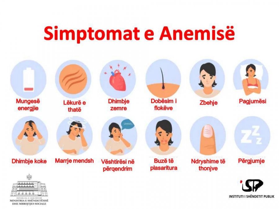 ISHP: Simptomat dhe trajtimi i  anemisë 