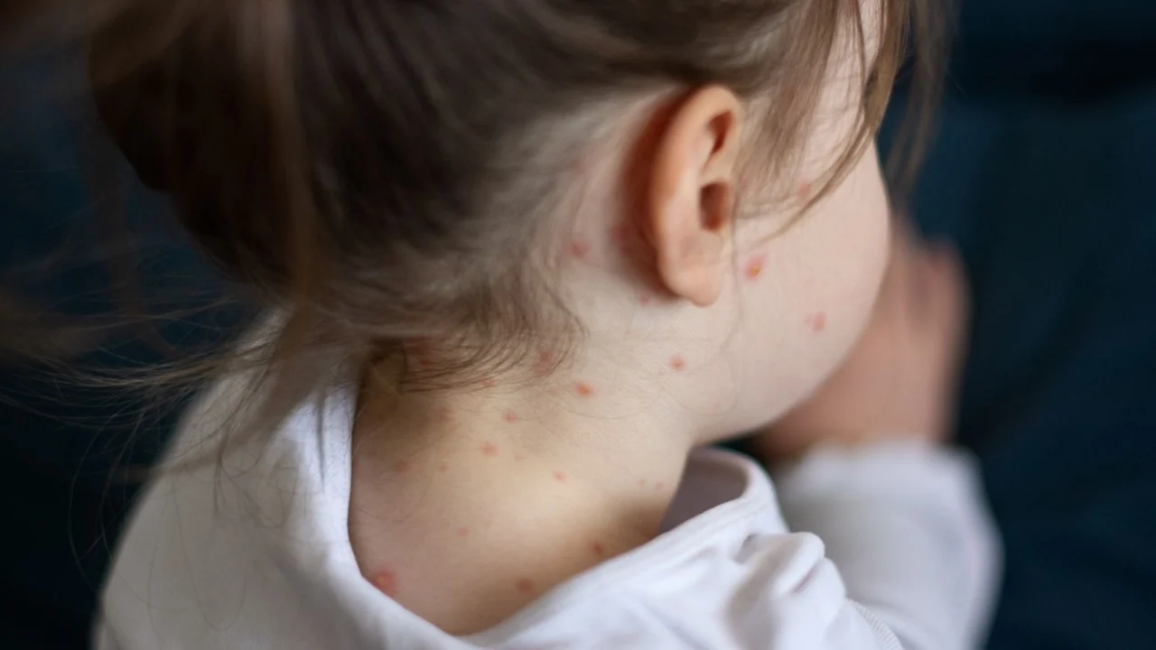 Alarmi për fruthin, ekspertët në Britani paralajmërojnë përhapjen e virusit vdekjeprurës: Vaksinoni fëmijët