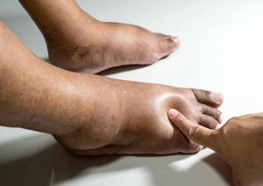 Këta janë shkaktarët më të shpeshtë të fryrjes së këmbëve