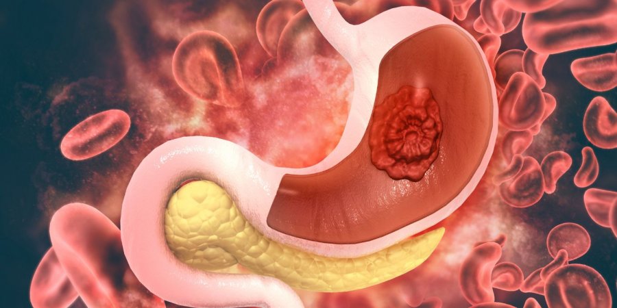 Shenjat e kancerit të stomakut mund të shihen në gojën e pacientëve vite përpara simptomave